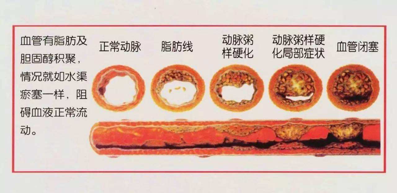 动脉粥样硬化_文章发表