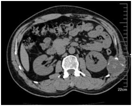 图1 软骨肉瘤CT 影像_期刊发表