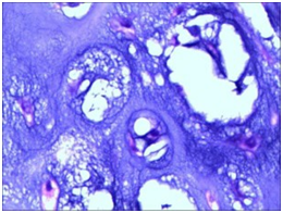 图2 软骨肉瘤病理切片( HE 染色，× 400)_期刊发表